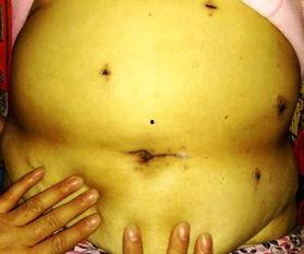 华西胃肠外科吃瓜